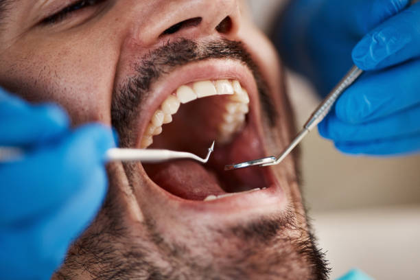 Best Chipped Tooth Repair Near Me  in Glenwood, IA