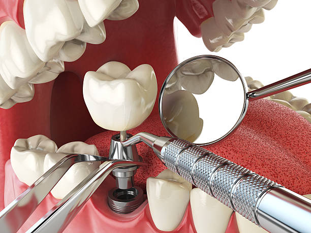 Best Cracked Tooth Emergency Dentist  in Glenwood, IA